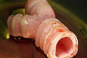 Искусственная трахея