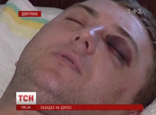 У одного из пострадавших разбит глаз