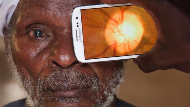 Galaxy S III используют для диагностики заболеваний глаз