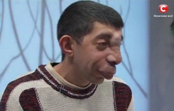 Я стесняюсь своего тела пересадка рук в руки Я стесняюсь своего тела пересадка рук в руки