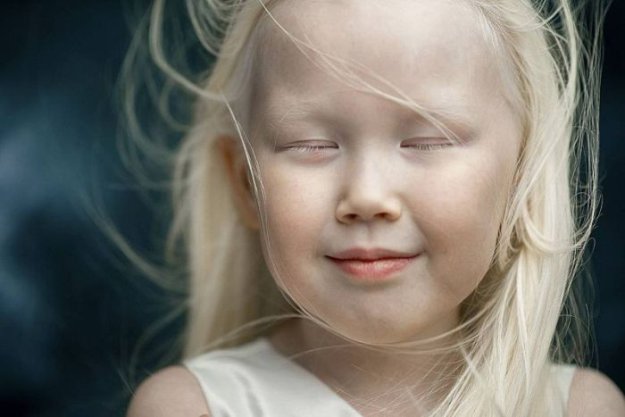 8-летняя девочка-альбинос Нарияна, которую зовут «Снежной королевой»