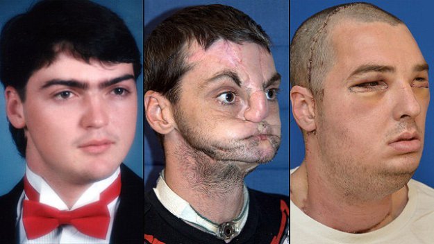 До и после пересадки лица