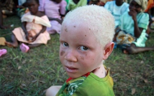 Негры альбиносы