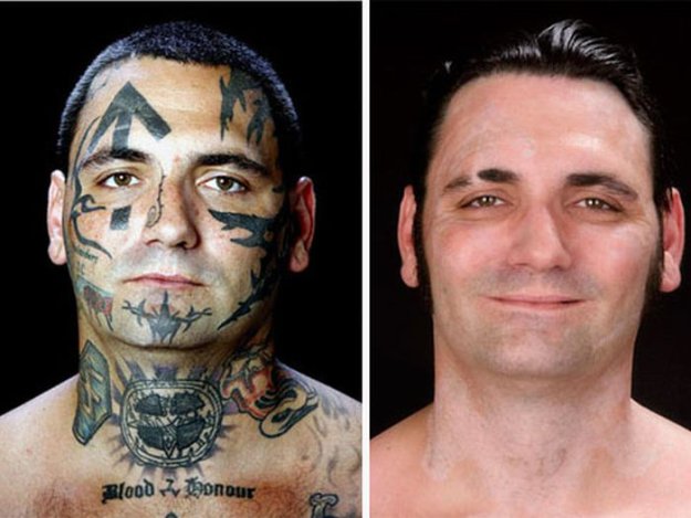 Удаление татуировок с лица