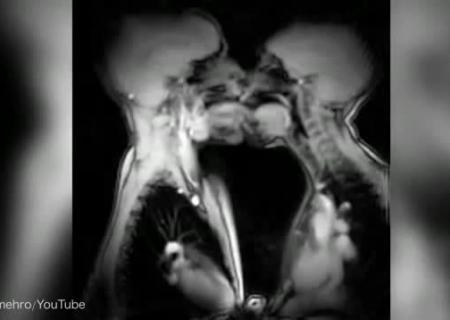 Как выглядит член внутри влагалища рентгеновские снимки
