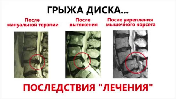 Ламинэктомия шейного отдела Ламинэктомия шейного отдела